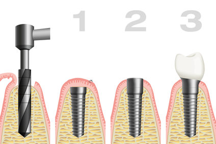 Schematische Zeichnung einer Zahnimplantation im Rahmen der Implantologie.