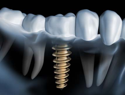 Darstellung eines Zahnimplantats