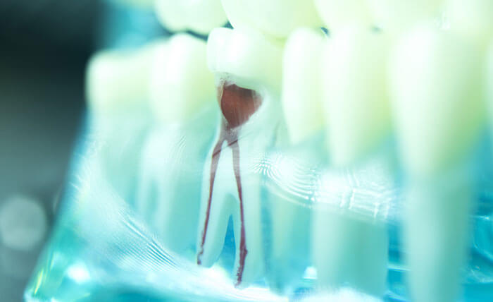 endodontie wurzelkanalbehandlung