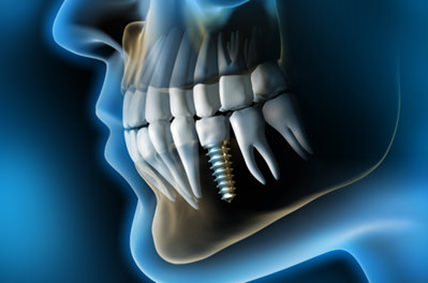 Röntgenaufnahme eines Patienten mit Zahnimplantaten als Sinnbild der Implantologie.