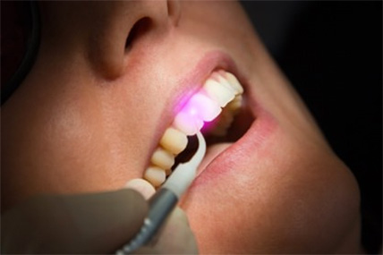 Patient erhält Parodontitis Behandlung mit dem Dental-Laser